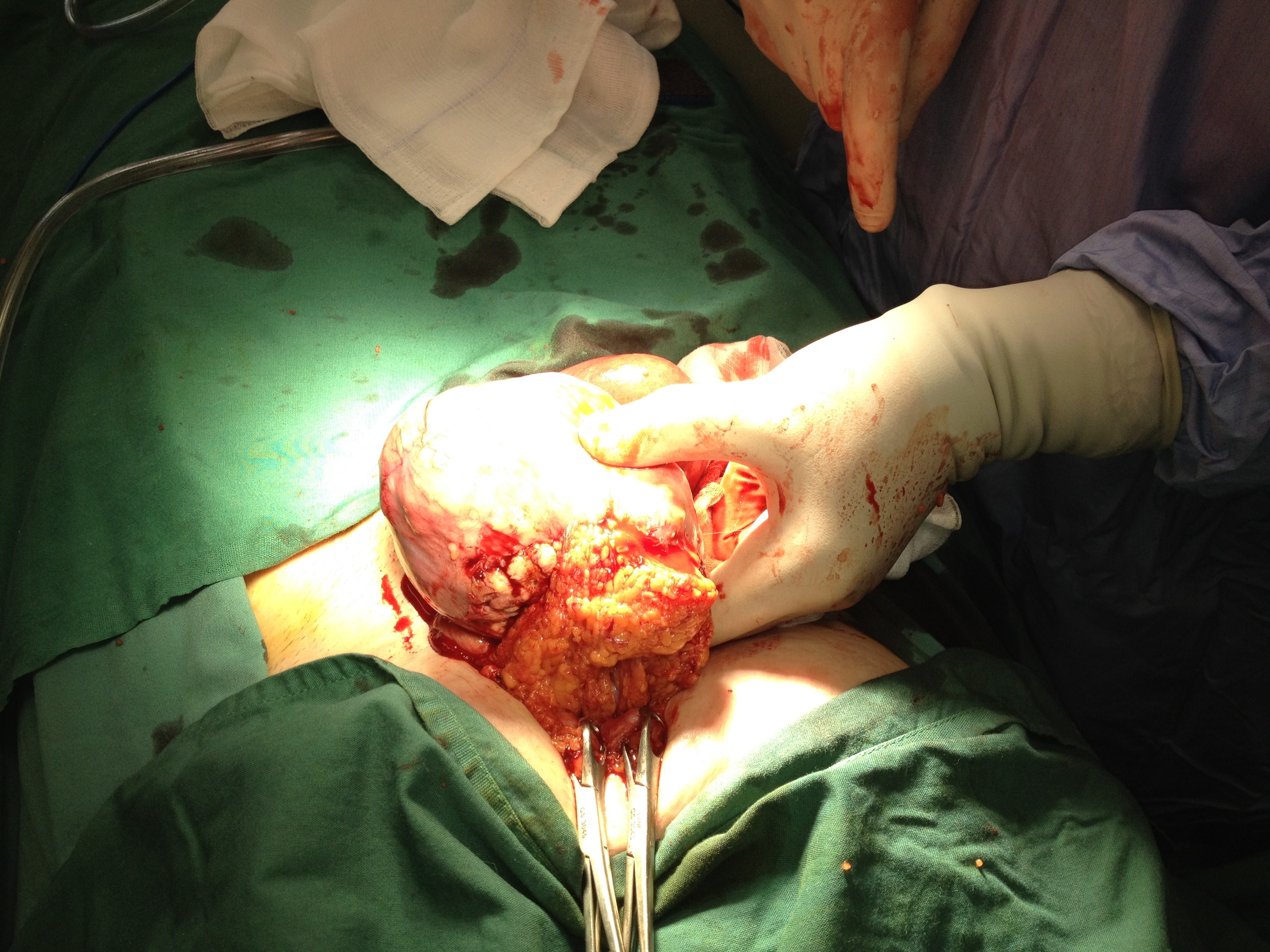 Uterine Artery Embolization Bowel Omental Adhesions to Fibroid Necrosis Serag Youssif